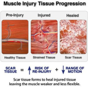 Muscle Adhesion - Apollo Soft Tissue and Spine