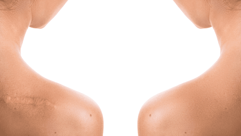 Healing from Within: Strategies to Eradicate Internal Scar Tissues ...